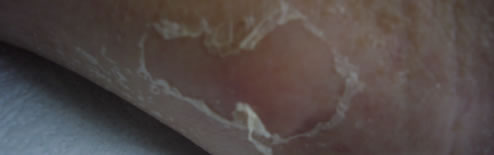 Blisters