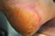 Anhidrosis (dry skin)