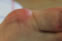 Bunions