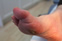 Chilblains