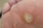 Corns & Callus