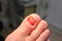 Ingrowing Toenails