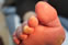 Mallet Toes 