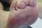 Retracted Toes