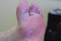 Rheumatoid Arthritis