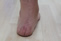 Severs Disease